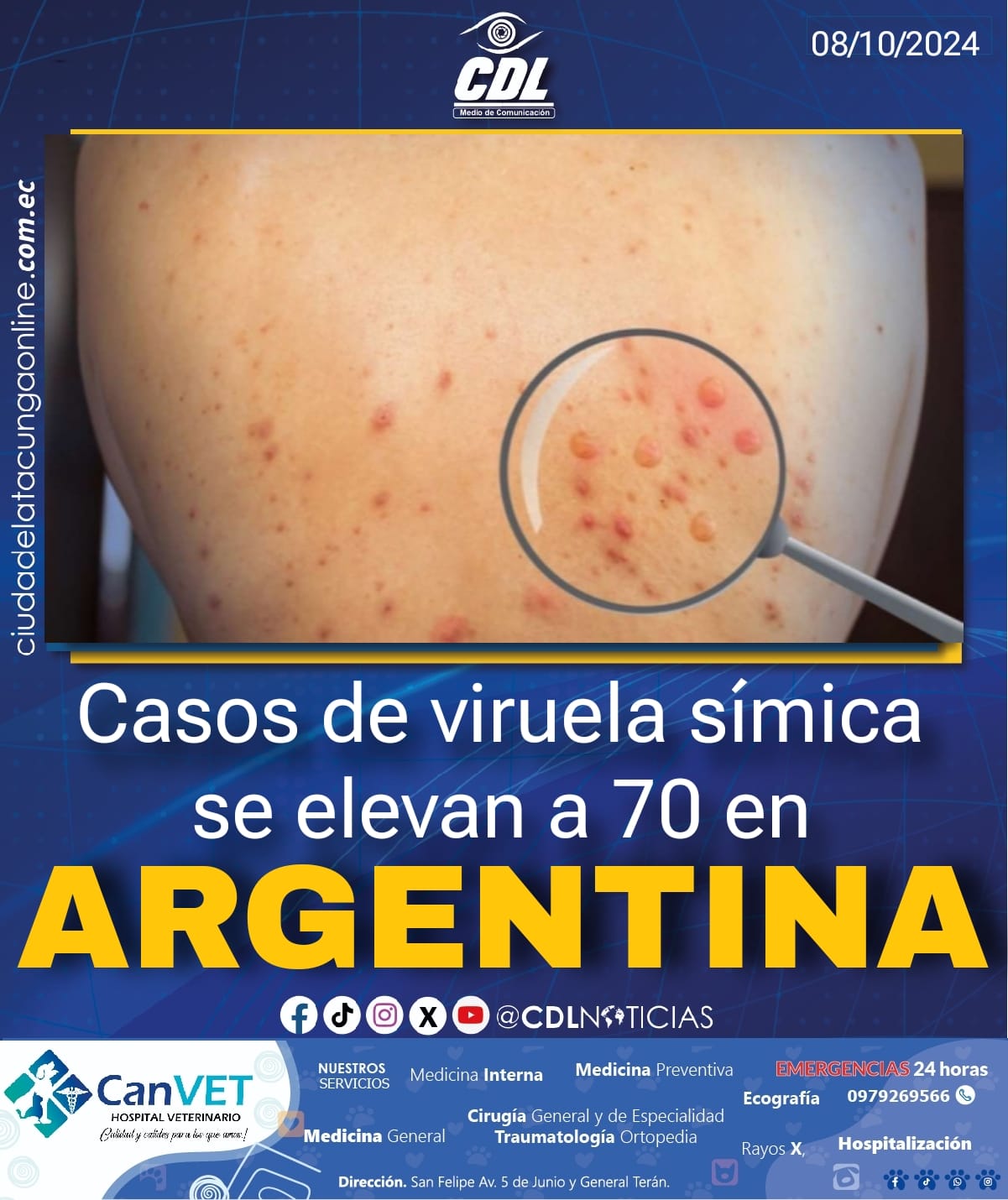 Casos de viruela símica se elevan a 70 en Argentina