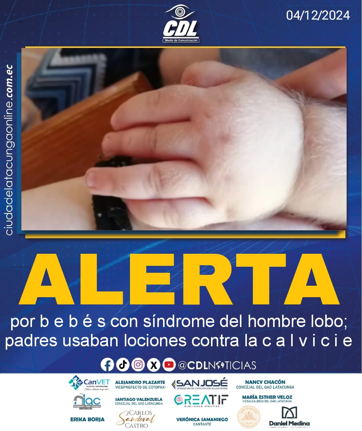 Alerta por b e b é s con síndrome del hombre lobo; padres usaban lociones contra la c a l v i c i e